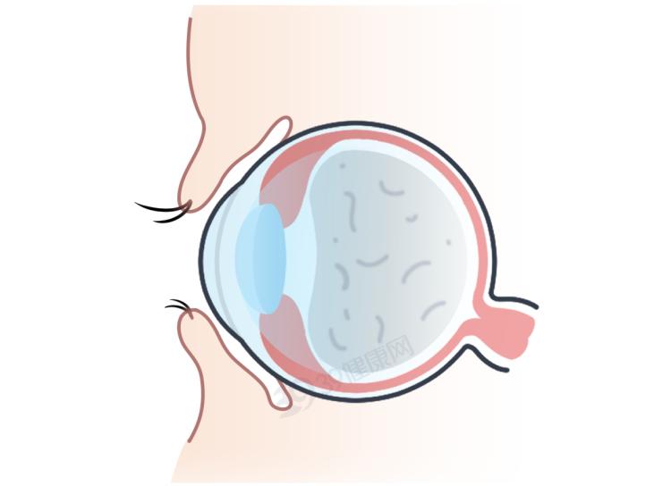 视网膜脱落症状_飞蚊症视网膜脱落_166006