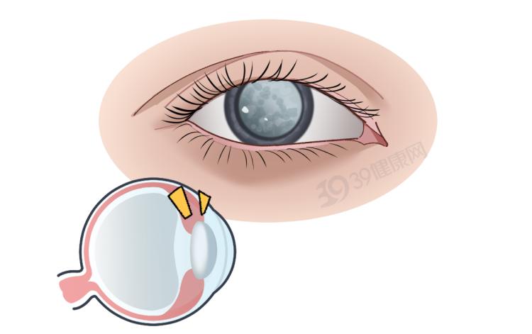视网膜脱落症状_飞蚊症视网膜脱落_166006