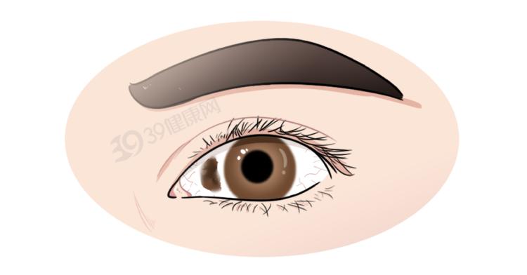 飞蚊症视网膜脱落_166006_视网膜脱落症状